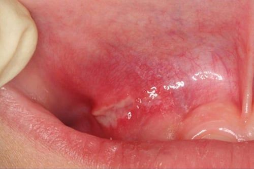 Canker Sores Aphthous Ulcer Causes Symptoms Diagnosis Stockton 