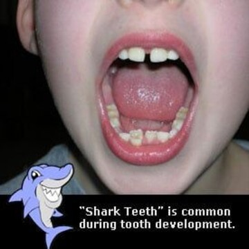 My child is getting shark teeth what can i do?