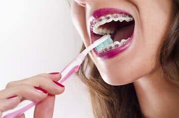 Brushing with Orthodontics